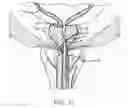 Fig. 13 - SHEATH ASSEMBLY FOR A TRANSURETHRAL PROCEDURE