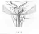 Fig. 14 - SHEATH ASSEMBLY FOR A TRANSURETHRAL PROCEDURE