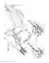 Fig. 02 - Post-implantation tension adjustment in cardiac implants