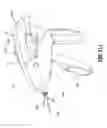 Fig. 77 - FLEXIBLE ENDOSCOPIC STITCHING DEVICES