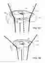 Fig. 05 - Knotless orthopedic stabilization system