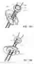 Fig. 08 - Knotless orthopedic stabilization system
