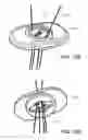 Fig. 09 - Knotless orthopedic stabilization system
