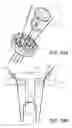 Fig. 11 - Knotless orthopedic stabilization system