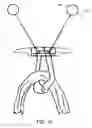Fig. 13 - Knotless orthopedic stabilization system