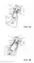 Fig. 20 - Knotless orthopedic stabilization system