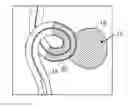 Fig. 01 - Vaso-occlusive devices including a friction element