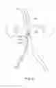 Fig. 07 - Devices and methods for treating acute kidney injury