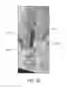 Fig. 35 - Devices and methods for treating acute kidney injury