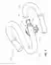 Fig. 02 - Vascular access assembly declotting systems and methods