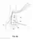 Fig. 34 - Systems and methods for using polyaxial plates