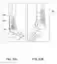 Fig. 22 - Systems and methods for using polyaxial plates