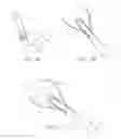 Fig. 02 - Method and device for uterine fibroid treatment
