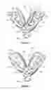 Fig. 03 - Overdenture and dental implant framework