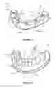 Fig. 04 - Overdenture and dental implant framework