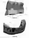 Fig. 15 - Overdenture and dental implant framework