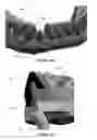 Fig. 17 - Overdenture and dental implant framework