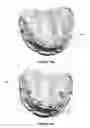 Fig. 20 - Overdenture and dental implant framework