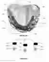 Fig. 22 - Overdenture and dental implant framework