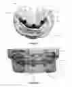 Fig. 23 - Overdenture and dental implant framework