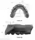 Fig. 25 - Overdenture and dental implant framework