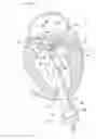 Fig. 09 - Heart valve docking devices and implanting methods