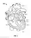 Fig. 02 - Transcatheter mitral valve design