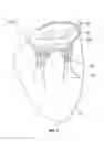 Fig. 03 - Transcatheter mitral valve design
