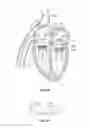 Fig. 06 - Methods, systems and devices for cardiac valve repair