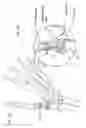 Fig. 02 - Prosthesis for replacing joint in a human hand or foot