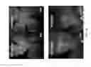 Fig. 02 - Methods of treating eye disorders with APLNR antagonists and VEGF inhibitors