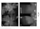 Fig. 06 - Methods of treating eye disorders with APLNR antagonists and VEGF inhibitors