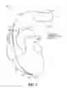 Fig. 02 - Post-hoc atrial fibrillation detection