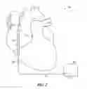 Fig. 03 - Post-hoc atrial fibrillation detection
