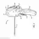 Fig. 03 - Anchor delivery system