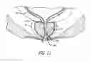 Fig. 13 - Anchor delivery system