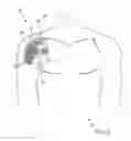 Fig. 03 - APPARATUS FOR FIXING SHEET-LIKE MATERIALS TO A TARGET TISSUE