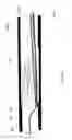 Fig. 32 - Atherectomy with subintimal space