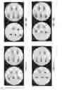 Fig. 15 - Bone screws and methods of use thereof