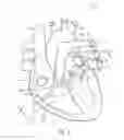 Fig. 02 - Mitral valve prosthesis delivery system