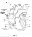Fig. 02 - Delivery system having a short capsule segment and a cinch mechanism and methods of use thereof