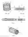 Fig. 03 - Tension management devices for stented prosthesis delivery device