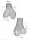 Fig. 02 - Total knee replacement implant based on normal anatomy and kinematics