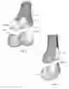Fig. 03 - Total knee replacement implant based on normal anatomy and kinematics