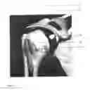 Fig. 02 - Orthopaedic shoulder implant