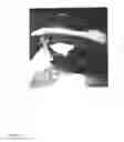Fig. 12 - Orthopaedic shoulder implant