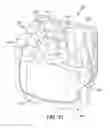 Fig. 30 - Implant with bone contacting elements having helical and undulating planar geometries