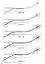 Fig. 06 - Low profile stent delivery system and method