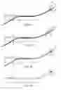 Fig. 07 - Low profile stent delivery system and method