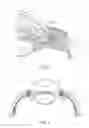 Fig. 02 - Delivery system for ocular implant